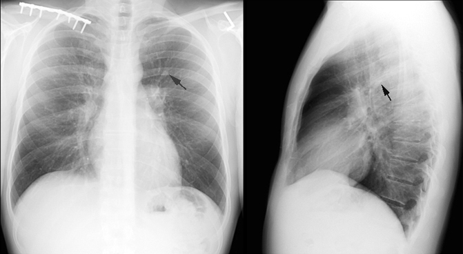 Pneumonia X Ray. A typical chest x-ray is shown