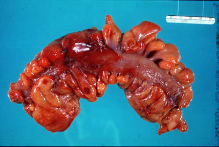 Acute Diverticulitis: A