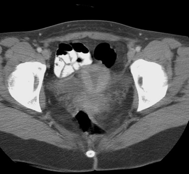 Ct Of Ovaries