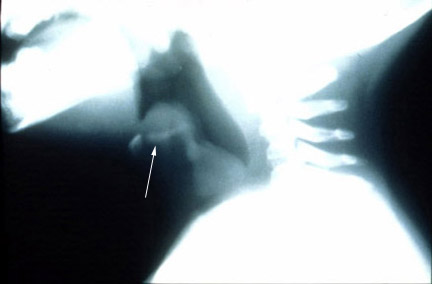 Epiglottitis x-ray - MEDKAAU