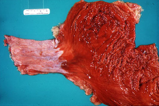Mallory Weiss Tear. Hemorrhagic gastritis: the