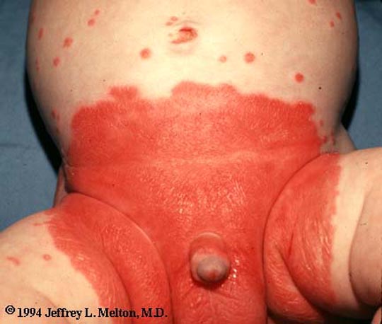 Diaper rash in infants and children - UpToDate