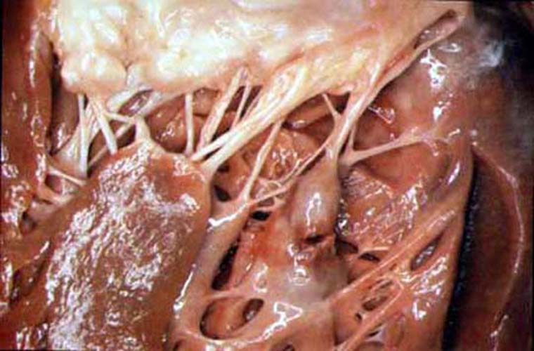 Images of Myocardial Infarction