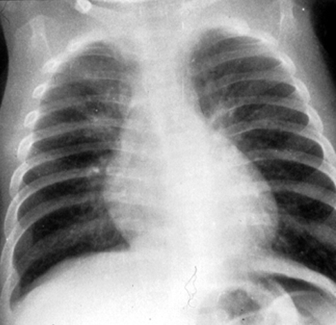 hyperinflated lung