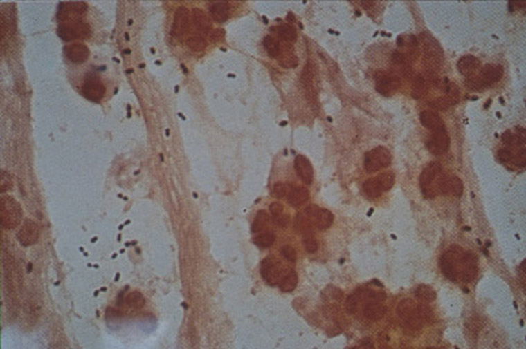 Streptococcus pneumonia: a gram stain of sputum reveals gram positive 