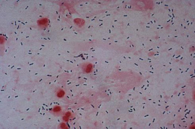 Sputum With Blood