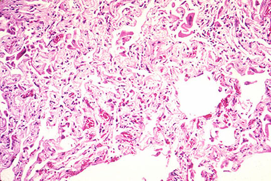 Image result for Mycoplasma pneumoniae gram stain