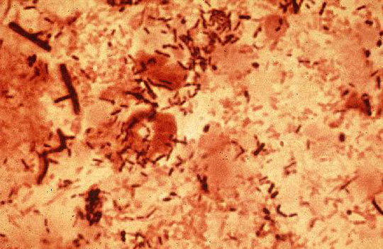 images of copd mycoplasma pneumoniae gram stain
