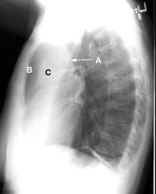 left lung atelectasis