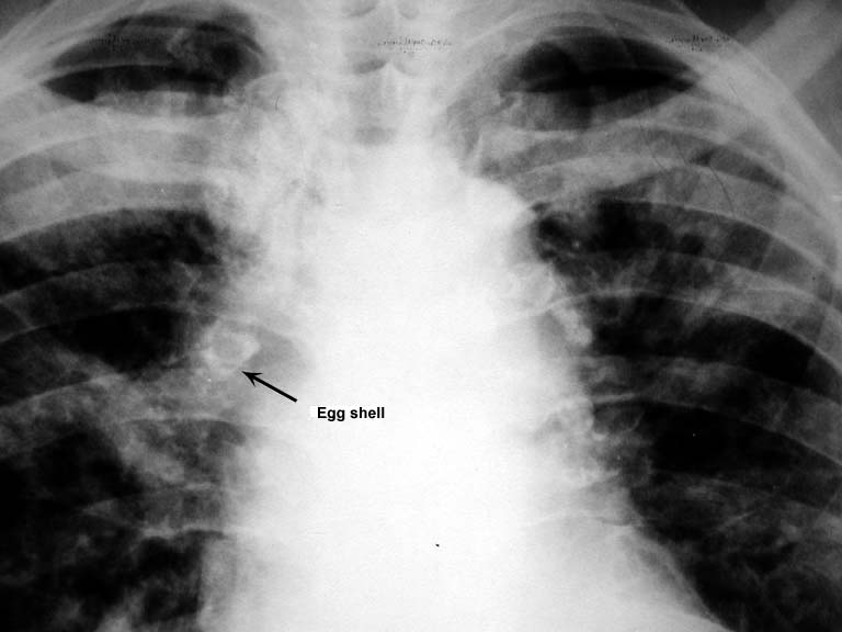 Eggshell Calcification Pulmonology Cases Flashcards Memorang
