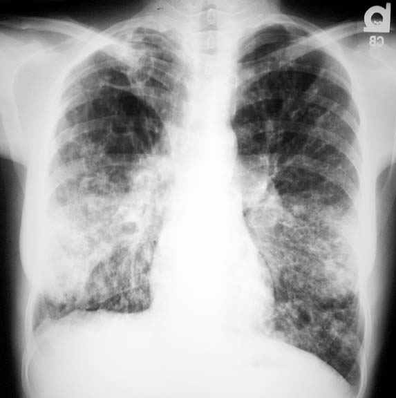 cystic fibrosis lungs. Cystic Fibrosis