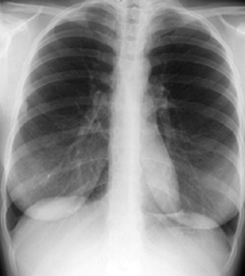 Î‘Ï€Î¿Ï„Î­Î»ÎµÏƒÎ¼Î± ÎµÎ¹ÎºÏŒÎ½Î±Ï‚ Î³Î¹Î± Chest X-ray