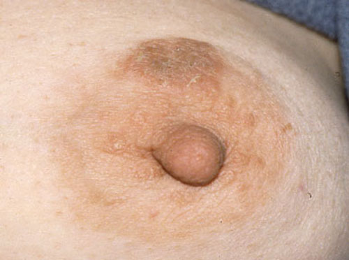 eczema on breast pictures