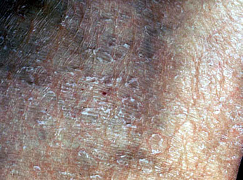 Liver Disease Skin