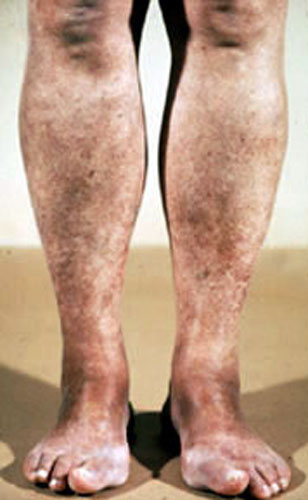 Liver Disease Skin