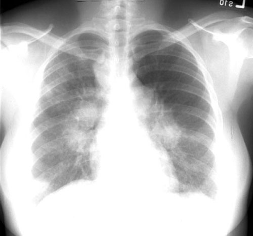 /xray/19al.jpg sarcoidosis