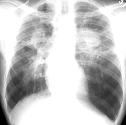 Mica pneumoconiosis: a neglected occupational lung disease - The Lancet  Respiratory Medicine