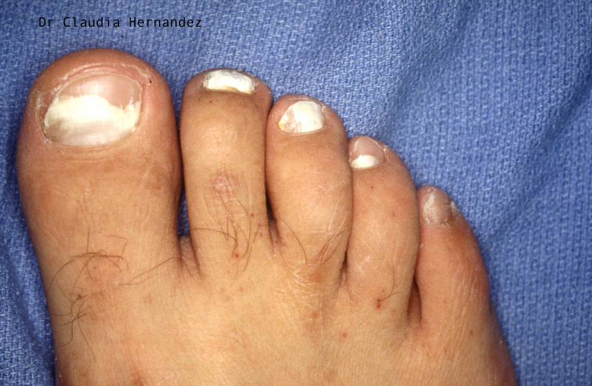 Gross/clinical images: toenail