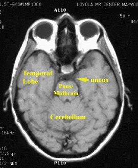 Krónikus prosztatitis az MRI- n)