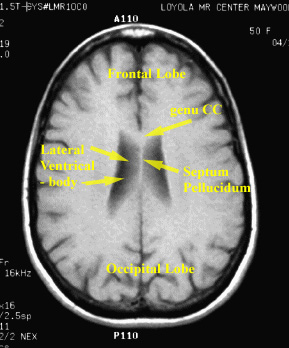 Krónikus prosztatitis az MRI- n