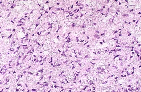 Fibrin Ring Granuloma Liver Causes Fibrin Ring Granuloma Liver Causes