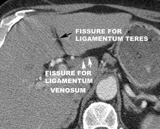 ligamentum teres outline