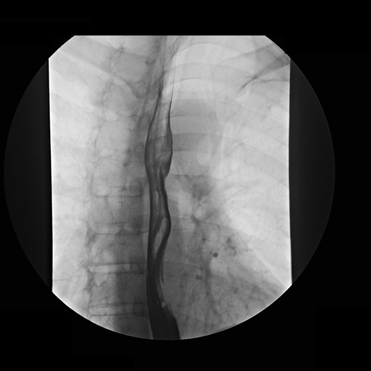 Course of Esophagus