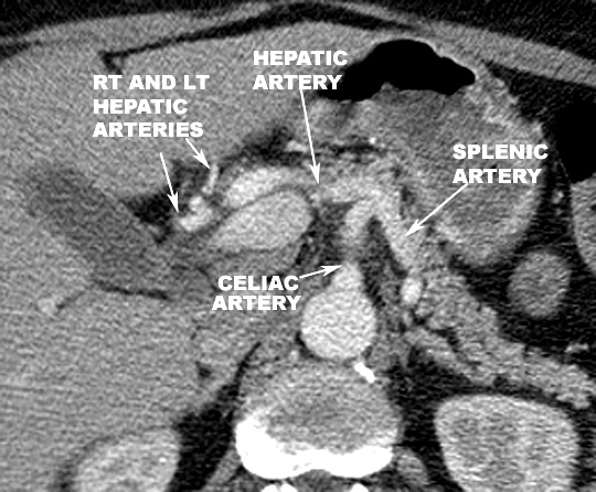 celiac artery branches click the image for labeling