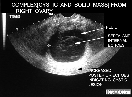 cancer ovarian lesions)