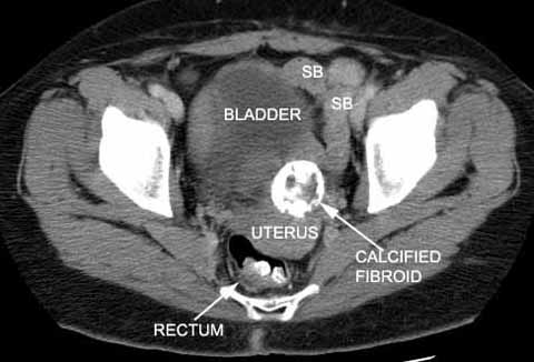 CT Calcified Fibroid. Rectum has contrast from a previous procedure.
