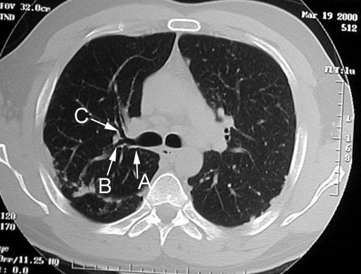 Locate portions of Aorta