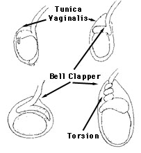 Bell Clapper Deformity Of Scrotum