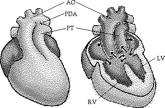 Transposition of the Great Vessels