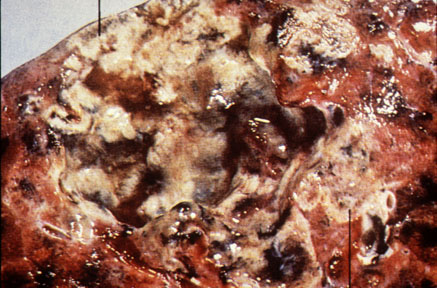 tuberculosis