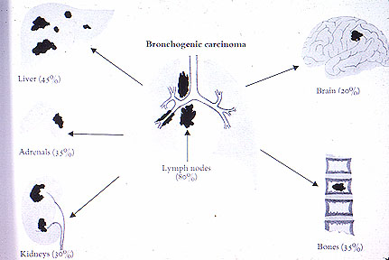 Lung Neoplasms 