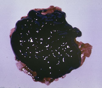 我这种情况是胃出血吗?