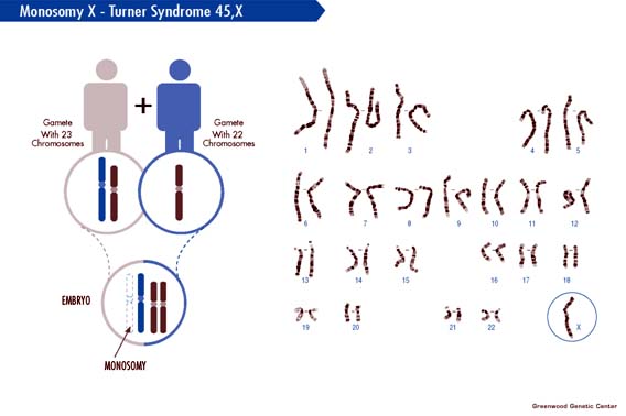 Ring Chromosome 14 Syndrome - Child Neurology Foundation