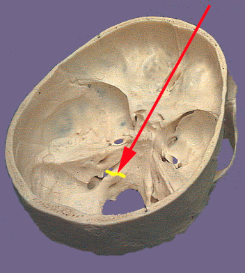 Cranium CN IX