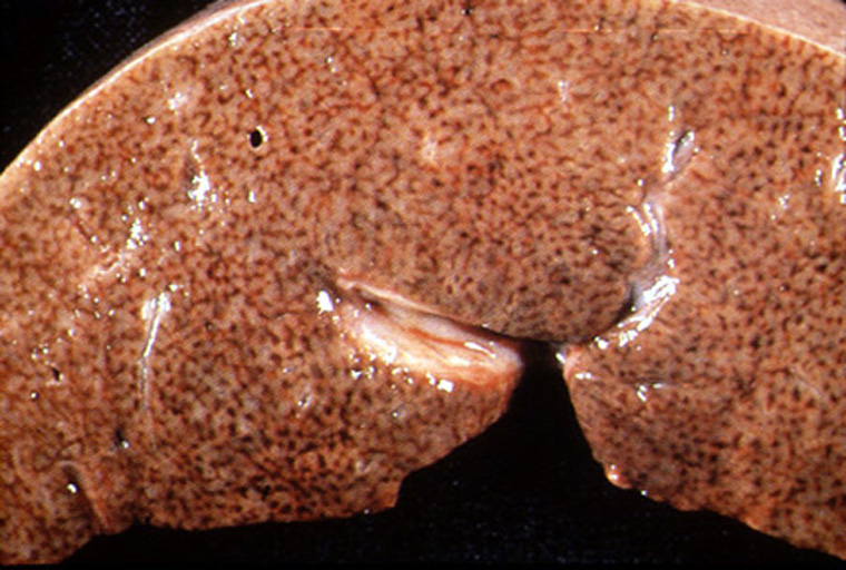 Images of congestive heart failure