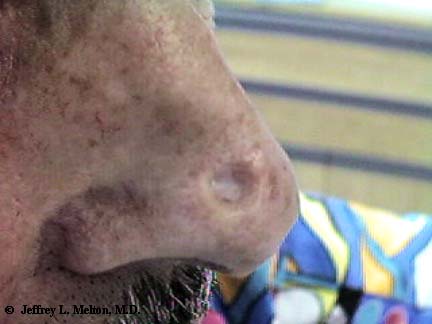 basal cell carcinoma nose scar