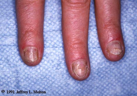 Terry's nails - Physical Diagnosis PDX