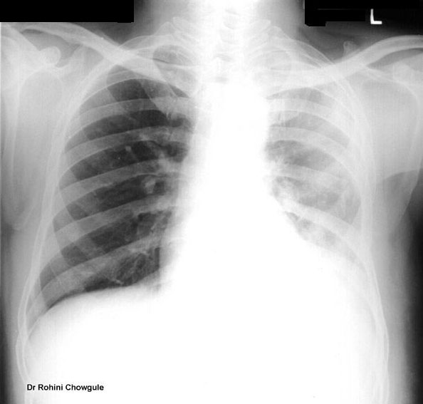 Unilateral Haziness Chest Wall Swelling