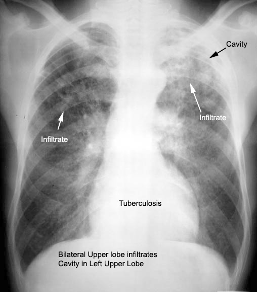 Cavity In Chest X ray Radiology