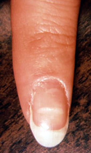 Nail signs of Disease | Nail pitting | Finger clubbing | Signs of anemia |  Terry's nails - YouTube