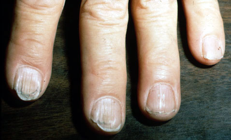 Drugâ•'induced Nail Changes