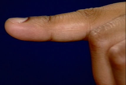 This change in your fingernails could be a sign of lung cancer