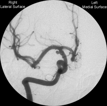 Anterior Cerebral Artery - Coronal Plane