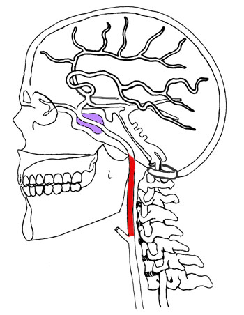 Cervical Carotid