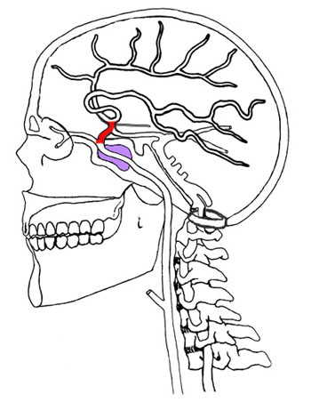 Cervical Carotid