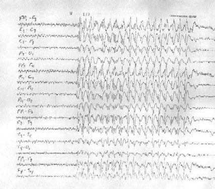 Case 4 - EEG